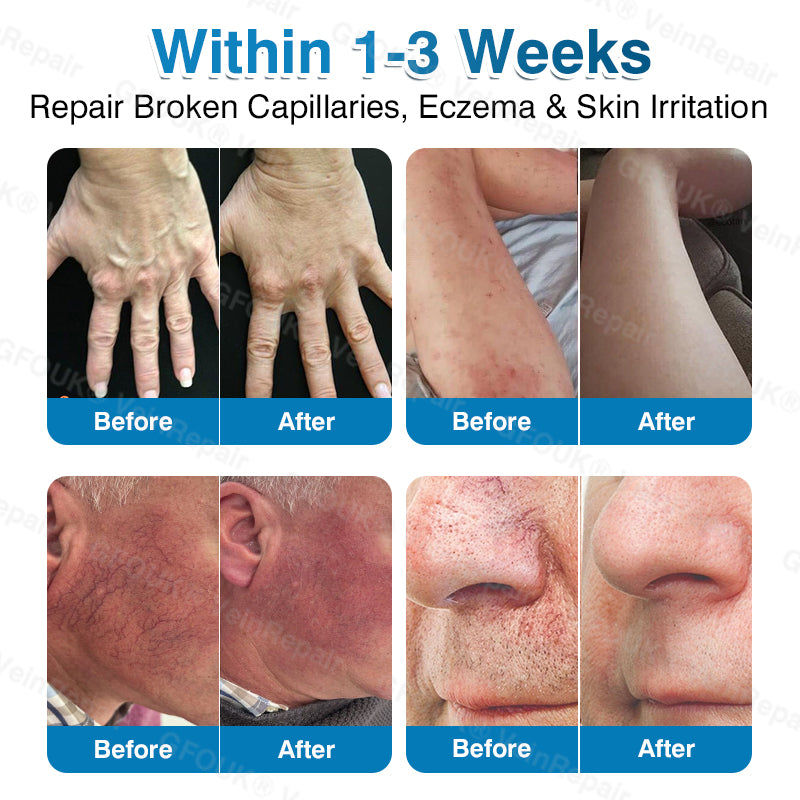 💛💛GFOUK® VeinRepair Microneedle Patch Roll⚡Instant Relief, Long-Term Results