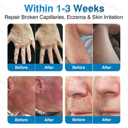 💛💛GFOUK® VeinRepair Microneedle Patch Roll⚡Instant Relief, Long-Term Results
