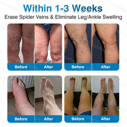 💛💛GFOUK® VeinRepair Microneedle Patch Roll⚡Instant Relief, Long-Term Results