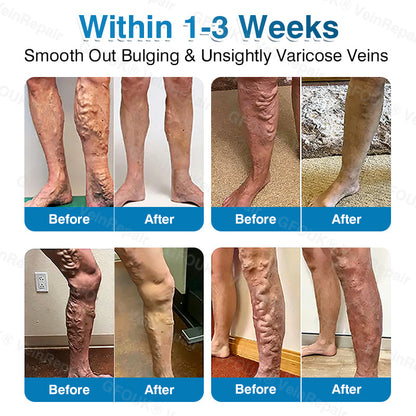 💛💛GFOUK® VeinRepair Microneedle Patch Roll⚡Instant Relief, Long-Term Results