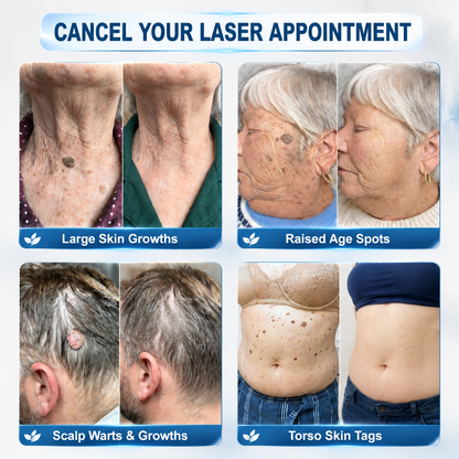 👩‍⚕️👑 𝐎𝐟𝐟𝐢𝐜𝐢𝐚𝐥 𝐒𝐭𝐨𝐫𝐞 | 𝑵𝐞𝒌𝐢𝐬𝐬® 🌿 𝐁𝐨𝐭𝐚𝐧𝐢𝐜𝐚𝐥 𝐌𝐢𝐜𝐫𝐨𝐧𝐞𝐞𝐝𝐥𝐞 𝐇𝐲𝐝𝐫𝐨𝐜𝐨𝐥𝐥𝐨𝐢𝐝 𝐏𝐚𝐭𝐜𝐡 (𝐅𝐨𝐫 𝐒𝐤𝐢𝐧 𝐓𝐚𝐠𝐬, 𝐒𝐦𝐚𝐥𝐥 𝐒𝐤𝐢𝐧 𝐆𝐫𝐨𝐰𝐭𝐡𝐬, 𝐖𝐚𝐫𝐭𝐬, 𝐌𝐨𝐥𝐞𝐬, 𝐀𝐠𝐞 𝐒𝐩𝐨𝐭𝐬 & 𝐏𝐢𝐠𝐦𝐞𝐧𝐭𝐚𝐭𝐢𝐨𝐧 𝐂𝐨𝐧𝐜𝐞𝐫𝐧𝐬)