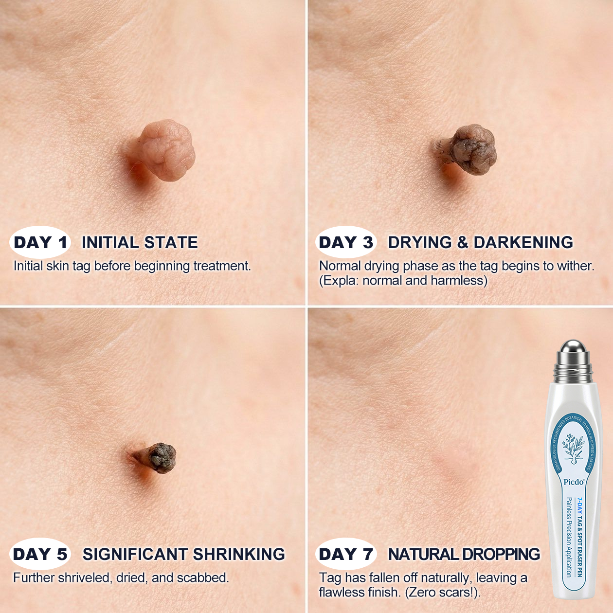 𝐏i𝐜𝐝o®🍁7-𝐷𝑎𝑦 𝗧𝐚𝐠 & 𝗦𝗽𝐨𝐭 𝐄𝐫𝒂𝒔𝒆𝒓(Zero Pain, Zero 𝐒𝐜𝐚𝒓𝒔 Rollerball)