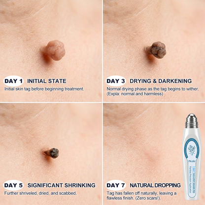 𝐏i𝐜𝐝o®🍁7-𝐷𝑎𝑦 𝗧𝐚𝐠 & 𝗦𝗽𝐨𝐭 𝐄𝐫𝒂𝒔𝒆𝒓(Zero Pain, Zero 𝐒𝐜𝐚𝒓𝒔 Rollerball)
